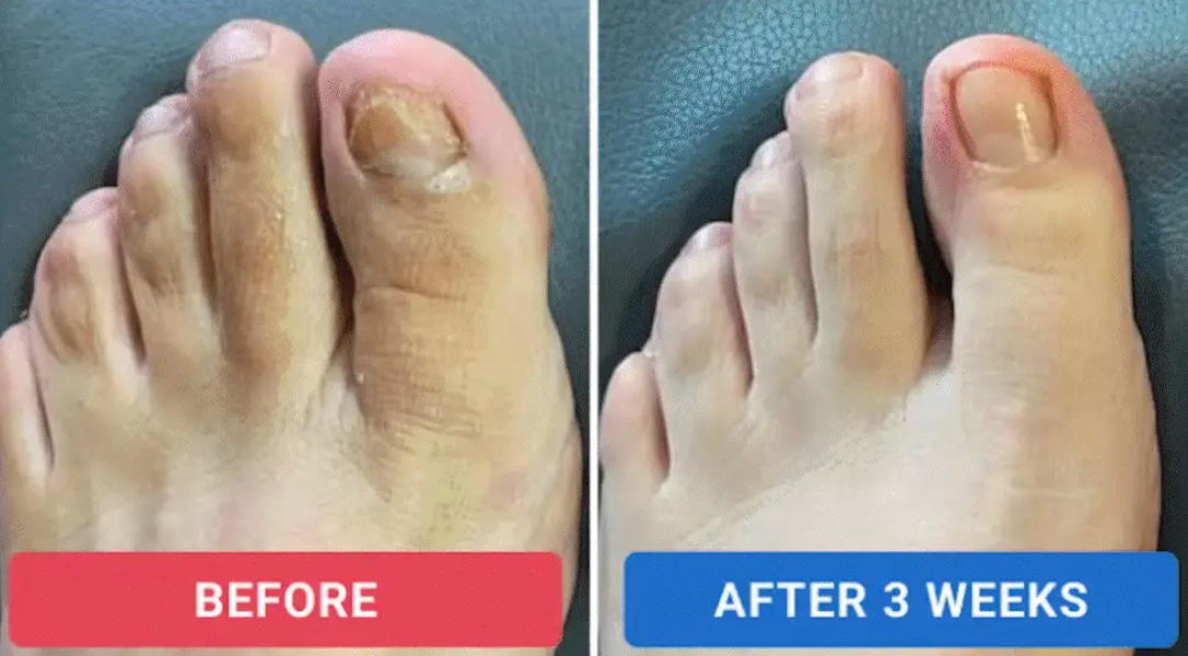 Roote  - Fungal Nail Patches