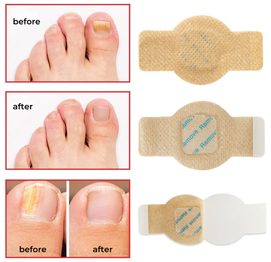 Roote  - Fungal Nail Patches