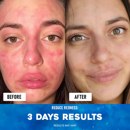 Premium Eczema Relief Cream with Sea Moss, Aloe Vera & Oats